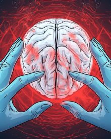 Ce este un anevrism cerebral? Cauze, simptome și tratament